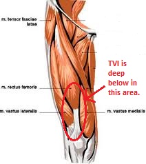 Researchers in Switzerland identify a new muscle called the tensor of vastus intermedius or TVI